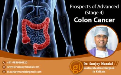 Prospects of Advanced (Stage 4) Colon Cancer – GI Oncosurgeon Explains
