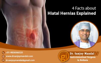 4 Facts about Hiatal Hernias Explained