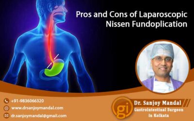 Pros and Cons of Laparoscopic Nissen Fundoplication