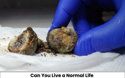 Can You Live a Normal Life Without a Gallbladder? What to Expect?