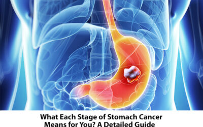 What Each Stage of Stomach Cancer Means for You? A Detailed Guide