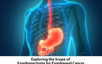 Exploring the Scope of Esophagectomy for Esophageal Cancer