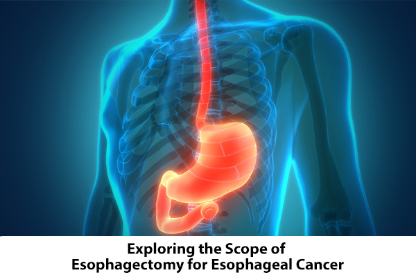 Exploring the Scope of Esophagectomy for Esophageal Cancer