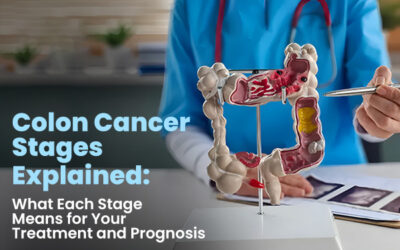 Colon Cancer Stages Explained: What Each Stage Means for Your Treatment and Prognosis