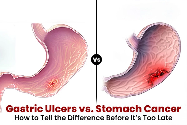 Gastric Ulcers vs. Stomach Cancer: How to Tell the Difference Before It’s Too Late